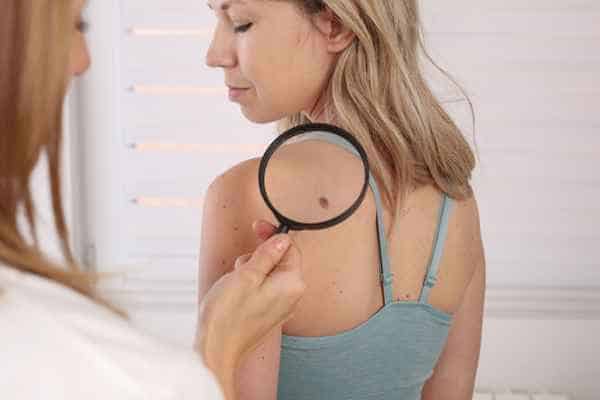 What Are Traditional Skin Lesion Removal Methods Essex?