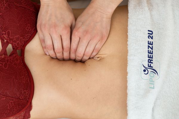diastasis recti treatment Essex
