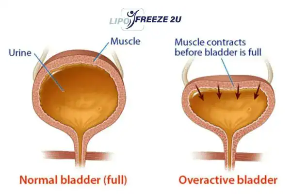 diagram of overactive bladder treatment Essex