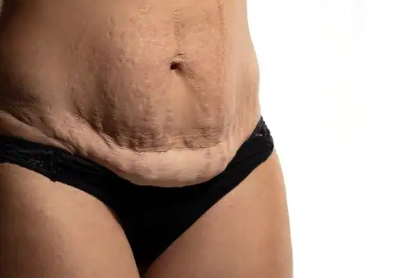 loose skin after weight loss injections Essex