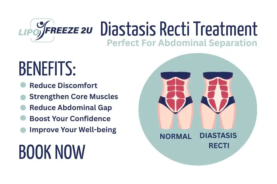 Benefits of body toning treatment Essex for Diastasis recti