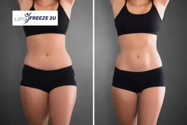 How Can LIPO FREEZE 2U Support Your Post-Pregnancy Body Recovery Essex?