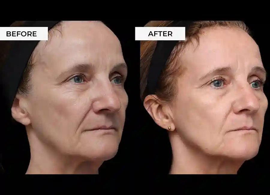 How Many RF Microneedling Sessions Will You Need to See a Difference Essex?