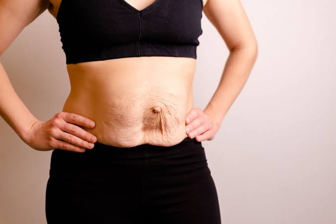 Is Surgery Really the Only Way to Repair Diastasis Recti Essex?