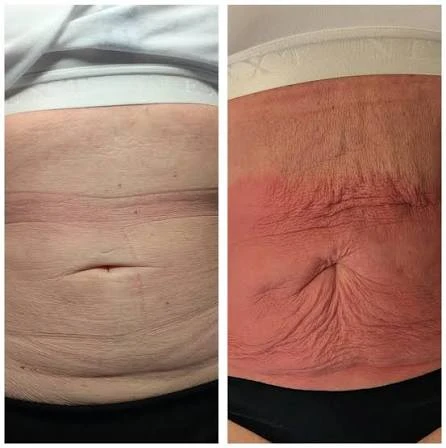 How Does RF Microneedling Improve Crepey, Thin and Uneven Skin Texture Essex?