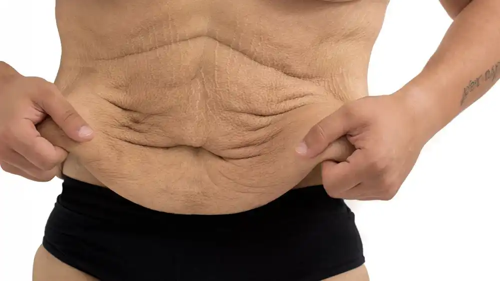 RF Microneedling for Loose Skin: How Can It Help Tighten and Reshape the Skin Essex?